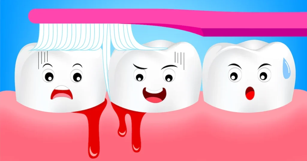 Is Bleeding Gums an Early Sign of Gum Disease Reading?