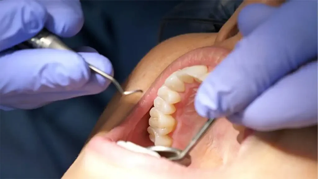 Receding gums