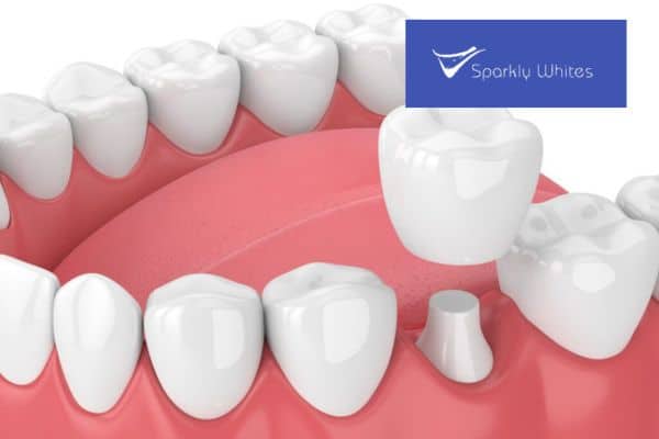 Filling, Crown, or Root Canal