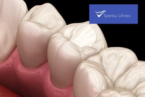 Filling, Crown, or Root Canal
