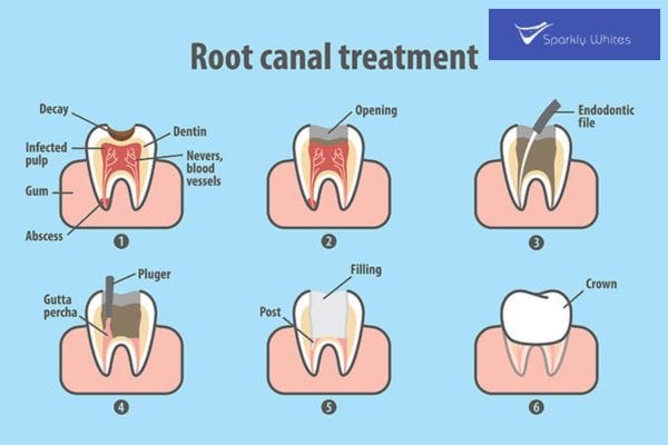 Filling, Crown, or Root Canal
